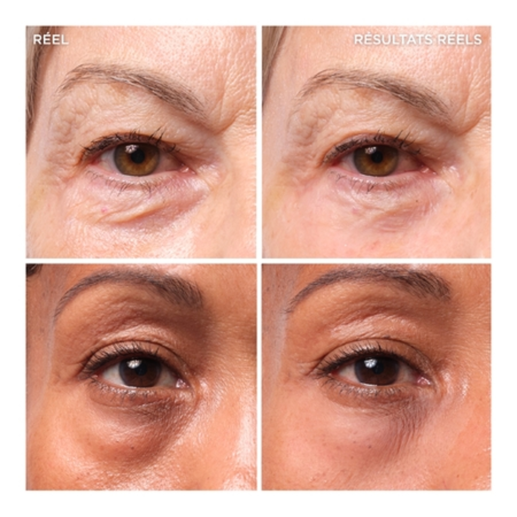BYE BYE UNDER EYE BAGSTraitement pour les poches