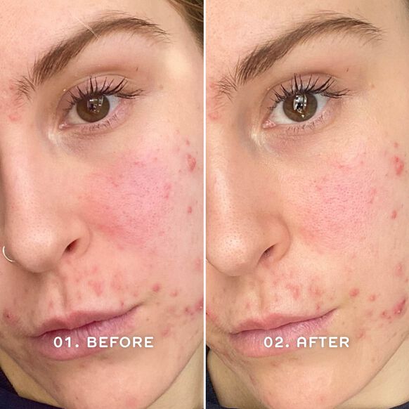 Ren Clean Skincare<br>Evercalm™ Redness Relief Serum