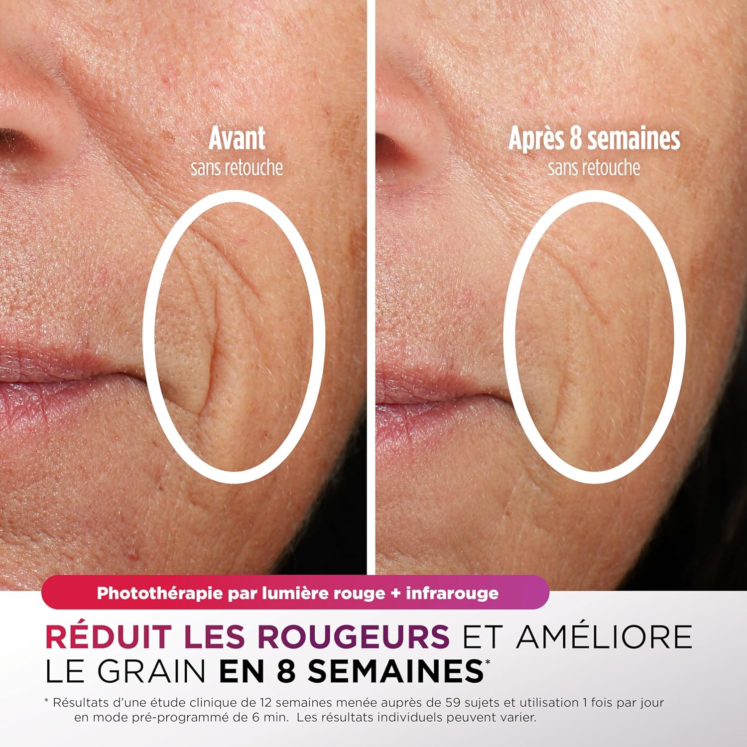 Shark CryoGlow LED Facial Mask - Lilac (Red/Blue/Infrared Light, USB-C, Remote Control)