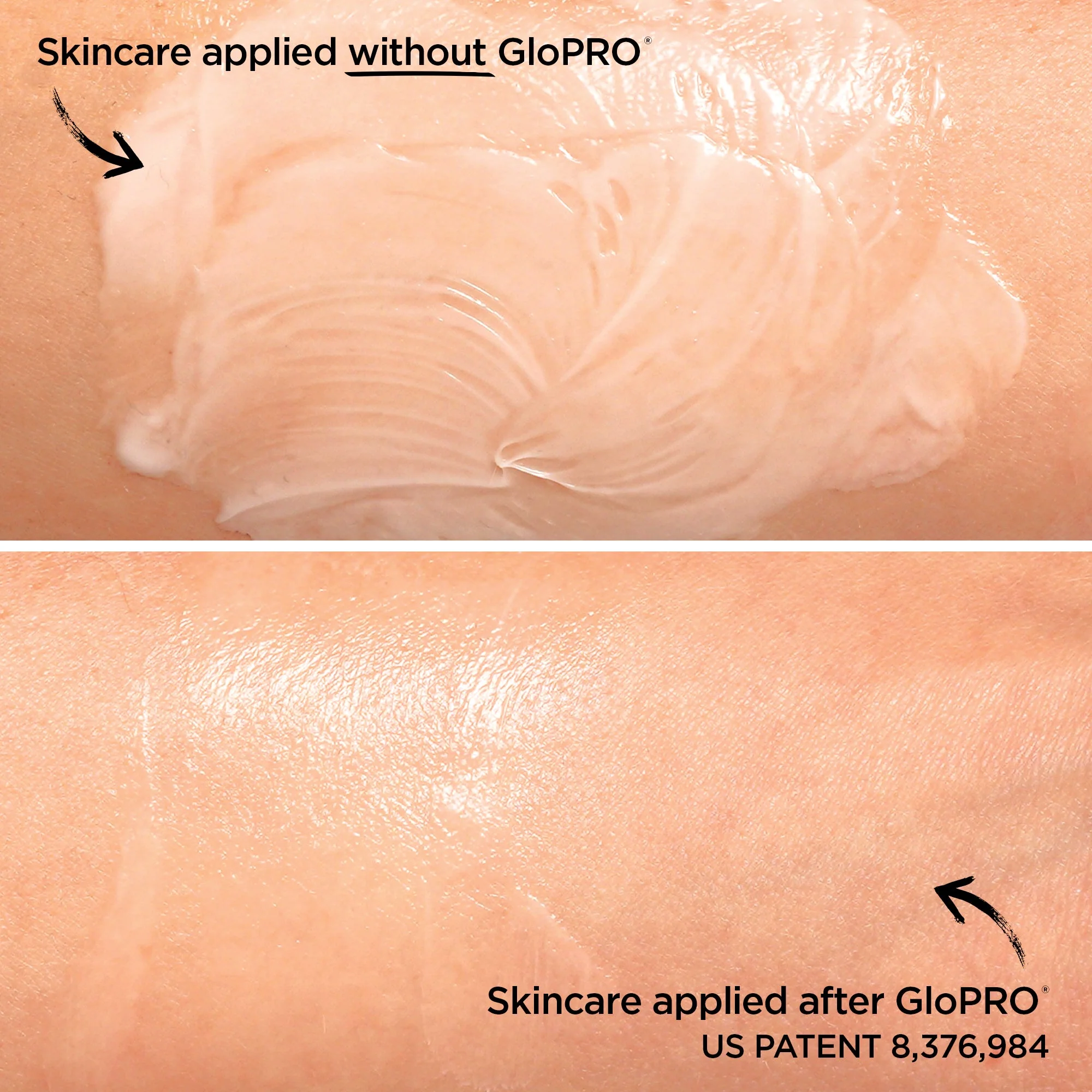 GloPRO® Facial Microneedling Tool