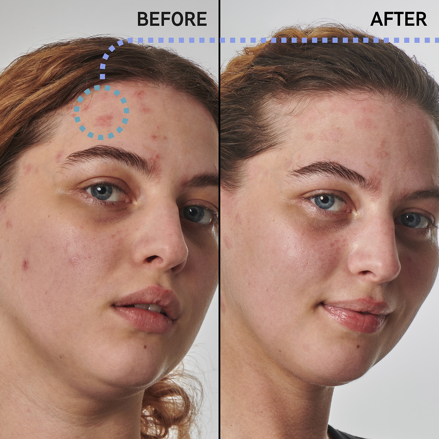 Soluci&oacute;n para pieles secas y rugosas con urea al 10% - Suero facial