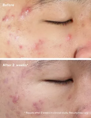 Deep Relief Blemish Treatment 30ml