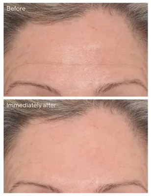 Rsg Targeted Wrinkle Corrector 15ml